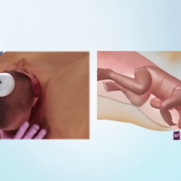 Procedure for Vacuum-Assisted Vaginal Delivery