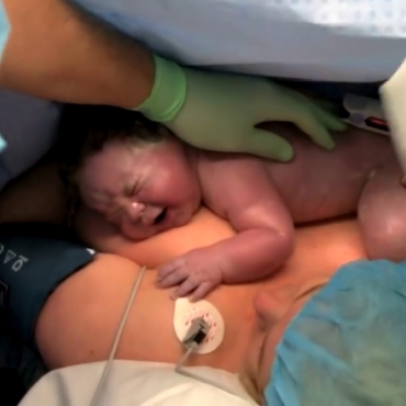 Skin-to-Skin Contact After Cesarean Birth