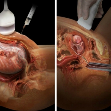 What Happens During a Chorionic Villus Sampling (CVS) Test?